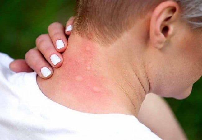Фото до матеріалу: На Львівщині росте кількість рідкісних паразитарних хвороб, що імітують рак та алергію