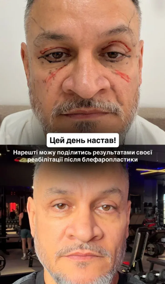 Фото до матеріалу: Ектор Хіменес-Браво показав фото після блефаропластики