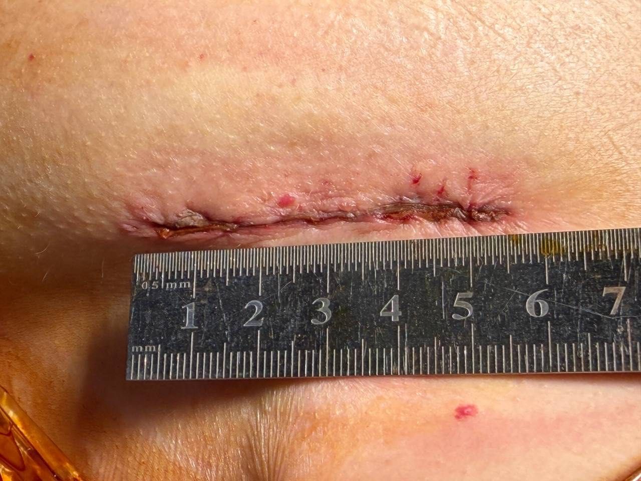 Фото до матеріалу: Історичний крок для рівненської медицини: перша операція на відкритому серці через мінірозріз