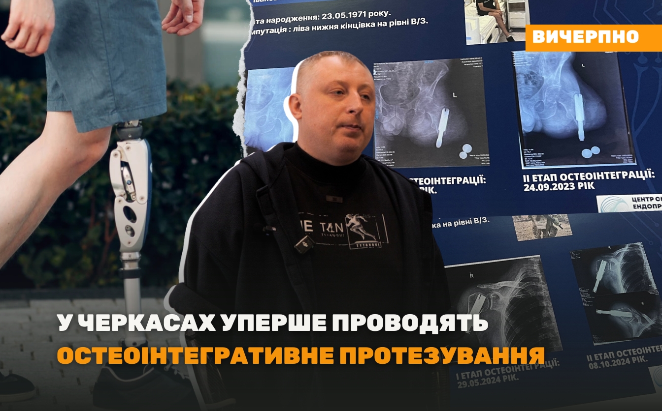 Фото до матеріалу: У Черкасах уперше проведуть остеоінтегративне протезування: повертають життя пацієнтам
