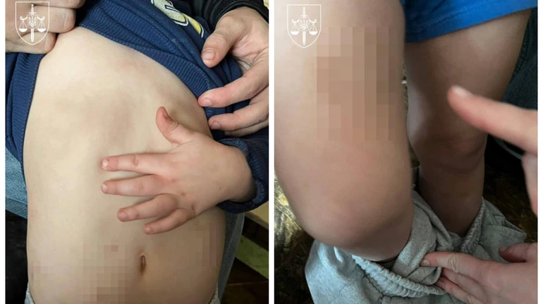 Фото до матеріалу: На Київщині засудили чоловіка, який бив дітей співмешканки до гематом