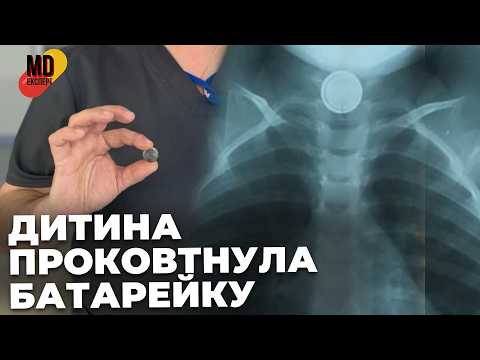 Фото до матеріалу: Львівські лікарі врятували життя: нова трансплантація та порятунок від батарейки
