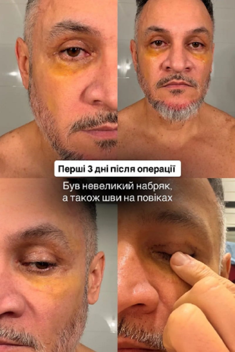 Фото до матеріалу: Суддя MasterChef Ектор Хіменес-Браво показав результат блефаропластики