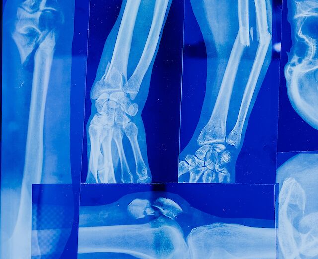 Фото до матеріалу: Як захистити кістки після 50 років: поради лікарів щодо профілактики остеопорозу