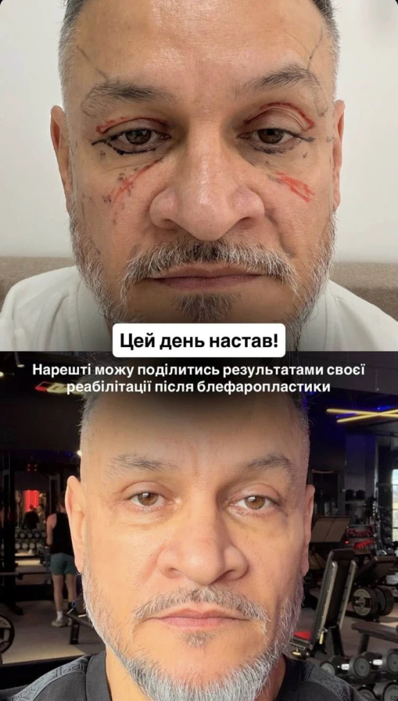 Фото до матеріалу: Суддя «МастерШеф» Ектор Хіменес-Браво показав результат підтяжки повік