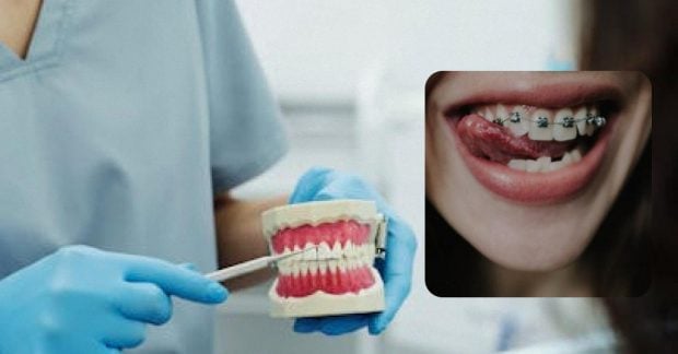 Фото до матеріалу: Скільки коштує встановити брекети в Києві: поради ортодонта та реальні ціни
