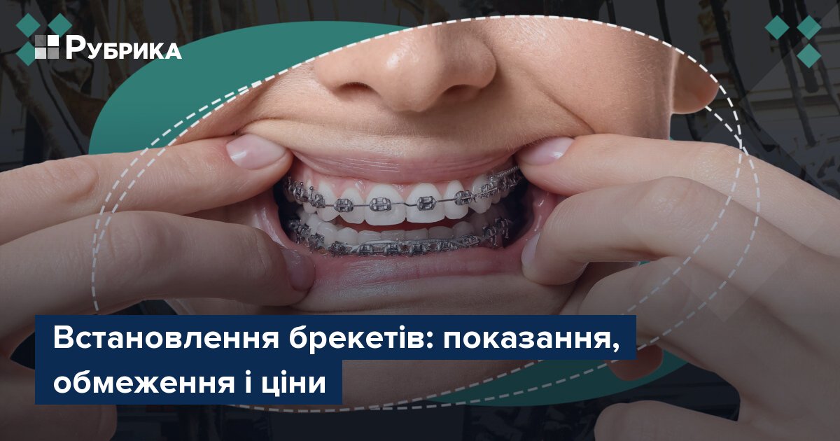 Фото до матеріалу: Вирівнювання зубів: коли брекети потрібні, а коли краще відкласти
