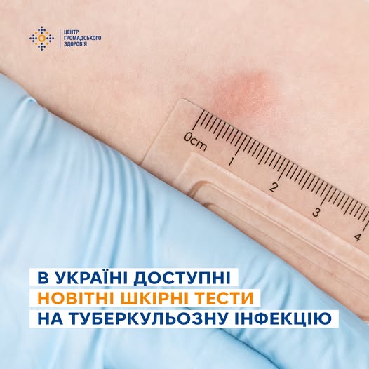 Фото до матеріалу: У Києві впроваджують сучасні шкірні тести для виявлення туберкульозу